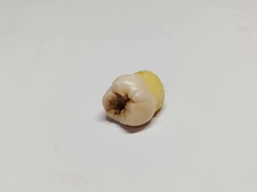 う蝕治療を受けた歯
